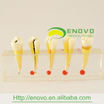 EN-M5 High Qualityresin Dental Pulp Disease Clinical Model for for Doctor-patient Communication Use